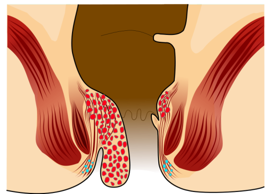 illustrative diagram of Piles treatment in pimple saudagar