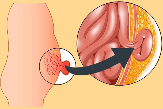 Anatomy diagram illustrating Hernia