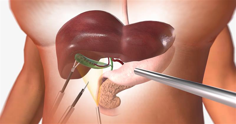 Ablation Therapy