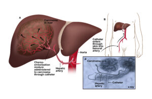 Transarterial Chemoembolization (TACE)