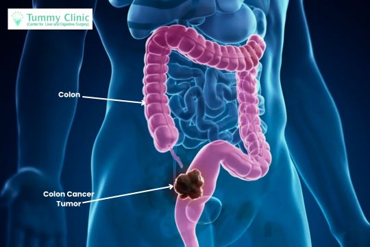 Colon Cancer Treatment in PCMC