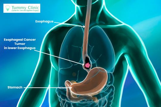 Esophageal Cancer Tumor showing in lower Esophagus. Get the best Esophageal Cancer Treatment in PCMC