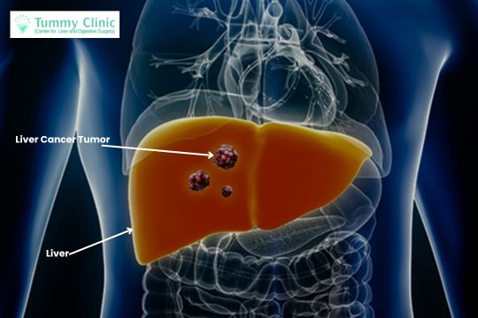 Human liver with cancer tumor infection