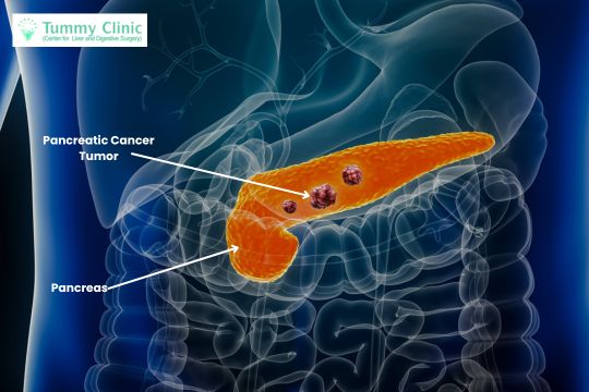 Pancreatic Cancer Treatment in PCMC At Tummy Clinic By Dr. Prakash Valse