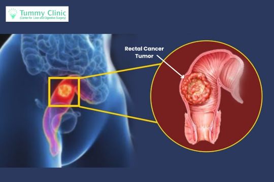 Rectal Cancer Treatment in PCMC At Tummy Clinic By Dr. Prakash Valse