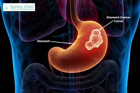 Stomach Cancer Treatment in PCMC At Tummy Clinic By Dr. Prakash Valse