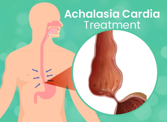 Achalasia Cardia Treatment