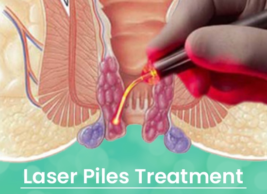 Laser Piles Treatment